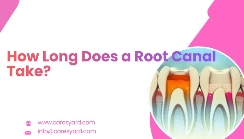 How Long Does a Root Canal Take