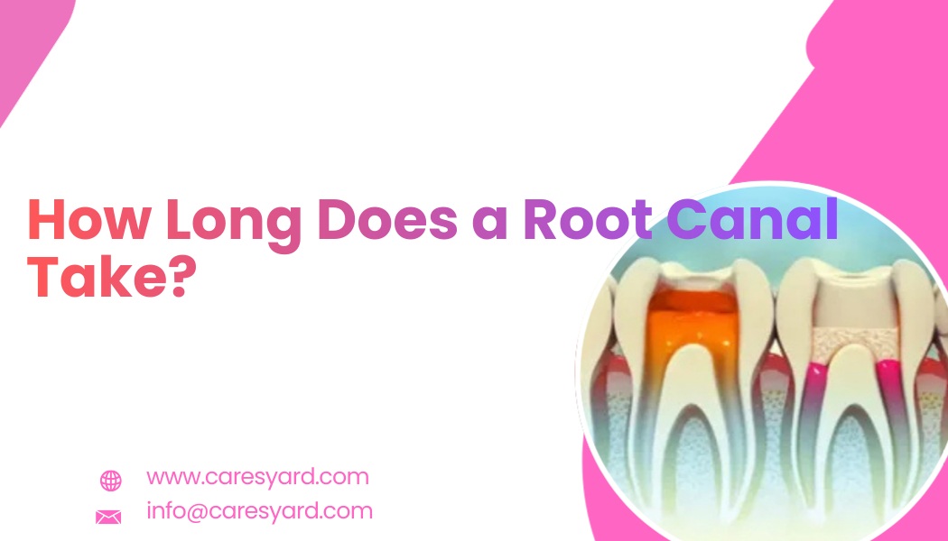How Long Does a Root Canal Take